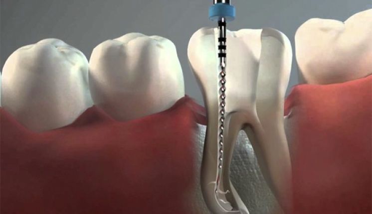 endodoncia