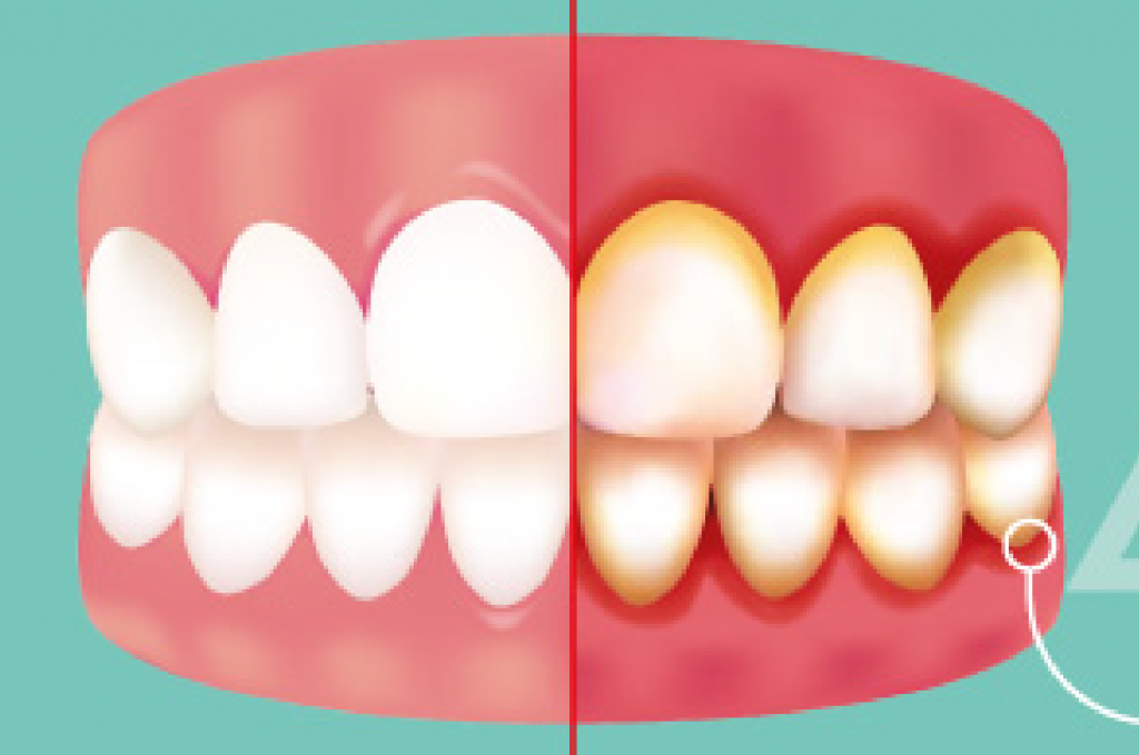 gingivitis