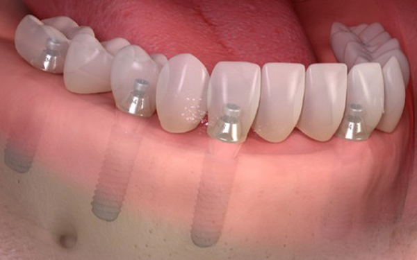 implantes arcada