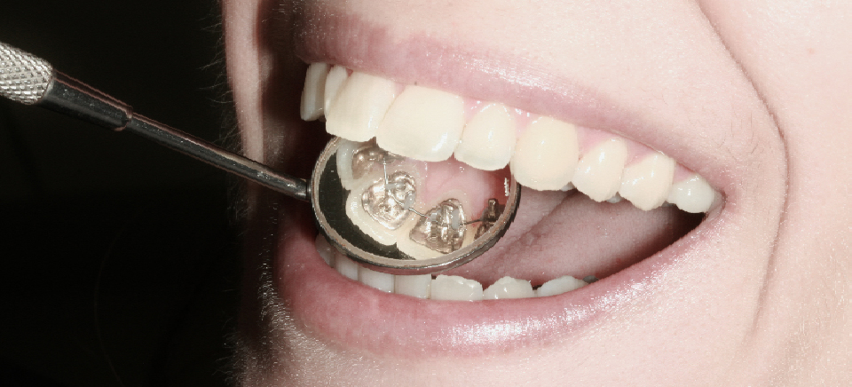 ortodoncia con brackets invisibles